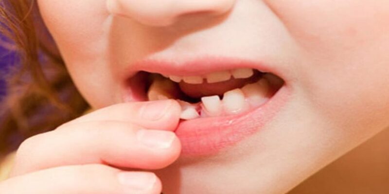 Những lý do dẫn đến giấc mơ răng rụng